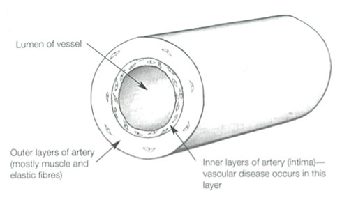 Vascular disease inroduction graph 1